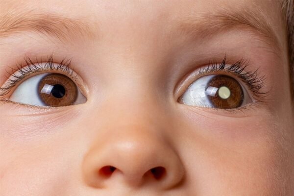 Entendendo o Retinoblastoma: A Luta Contra o Câncer Ocular Infantil